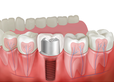 IMPLANT