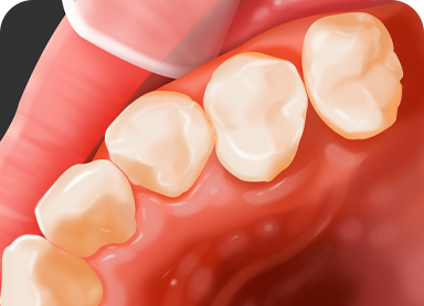 CAVITY TREATMENT