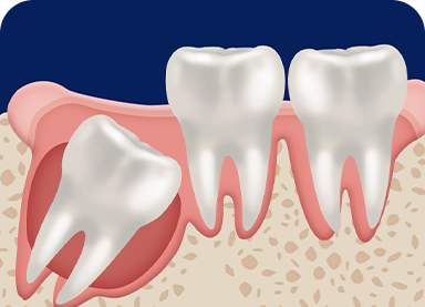 WISDOM TOOTH EXTRACTION